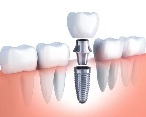 dental implants Weston MA