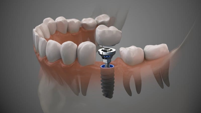 a digital image of a dental implant