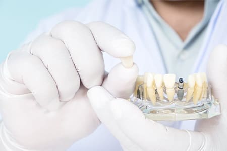 Dentist holding a dental implant crown