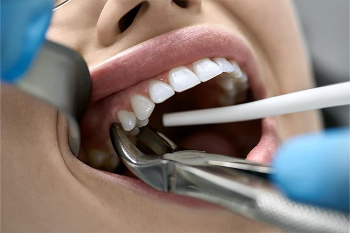 Dental forceps preparing to extract a patient’s tooth