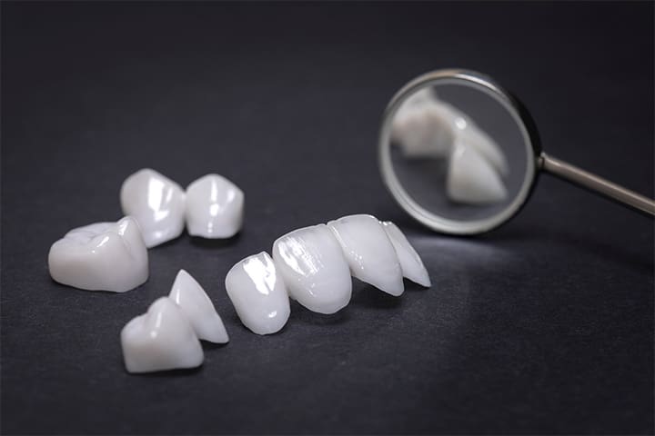 Example of veneers in Weston