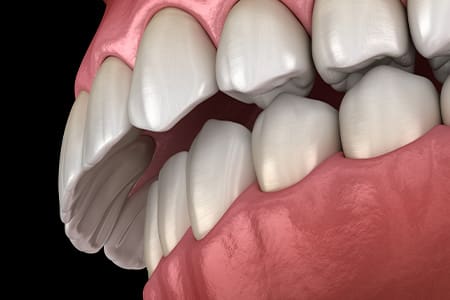 Example of bite misalignment.