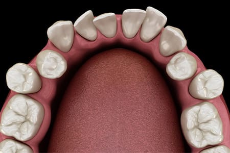 Example of crowded teeth.