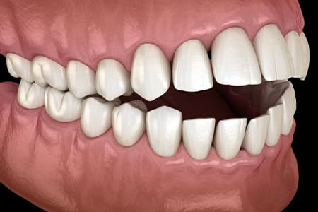 Illustration of an open bite.