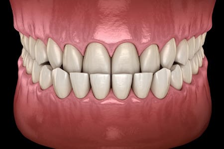 Illustration of an underbite.