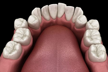 Illustration of crooked teeth.