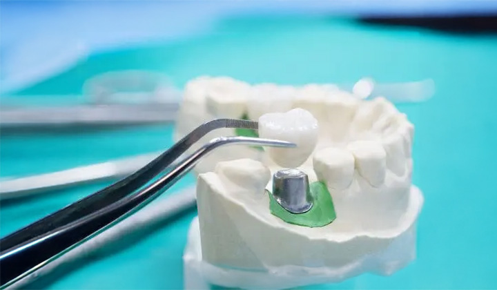 Dental implant model: tweezers holding a tooth crown above a dental implant on a jaw model.